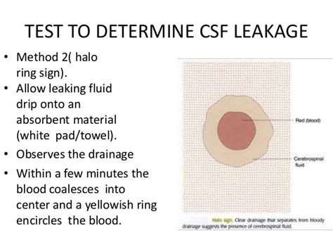 halo sign csf|Traumatic Cerebrospinal Fluid Leaks